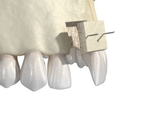 bone grafting placement photo